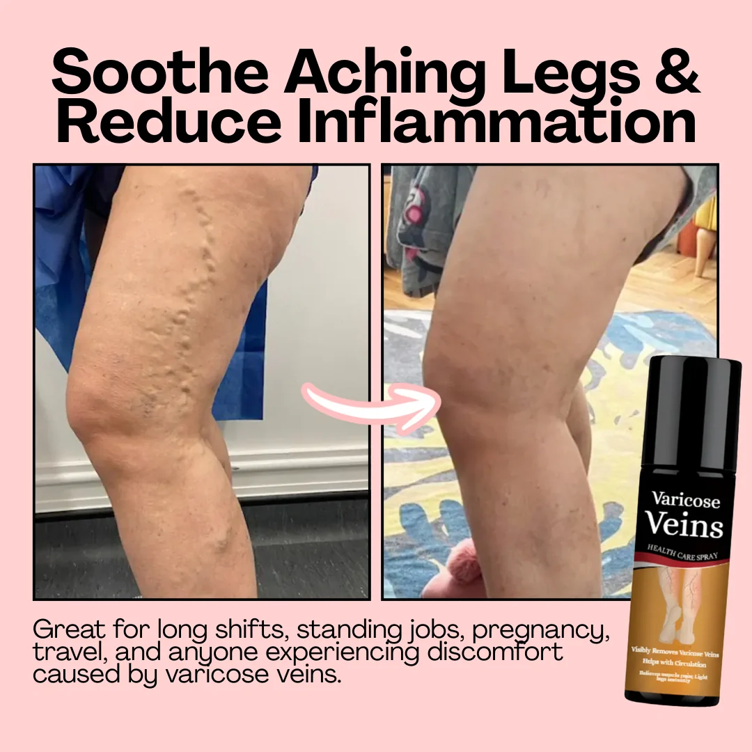 Varicose Vein Spray Leg Pain Gone, Confidence On - Image 5